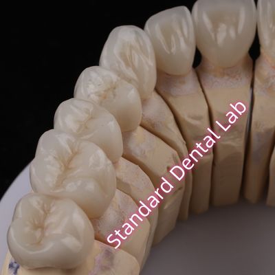 kopen Digitaal CAD CAM Tandheelkundig Lab PFZ Kronen Translucent Gelaagd Zirconia Kroon online vervaardiging