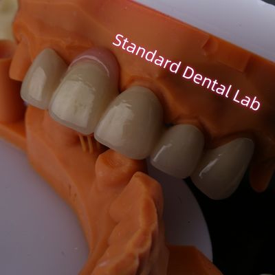 kopen Sterk biocompatibel PFZ porseleinen gelaagd zirconia met roze kauwgom online vervaardiging