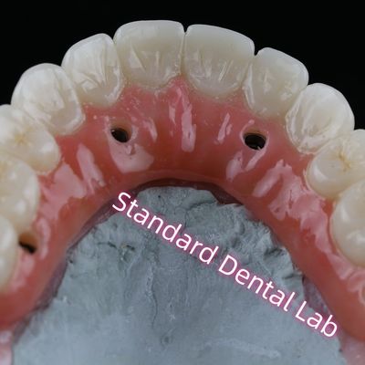 kopen Tandheelkundige implantaten Kroon PFZ Porselein gelaagd Zirconia schroef vastgehouden met roze kauwgom online vervaardiging