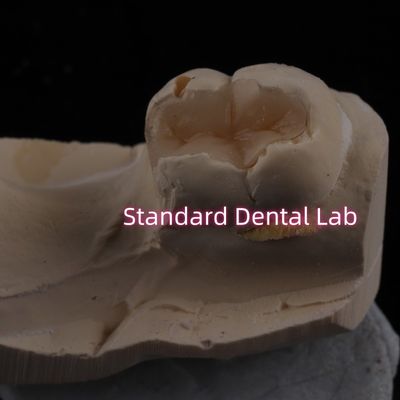 kopen Gegooid porselein tandheelkundig inlay Onlay Overlay Zirconia Emax High Esthetics online vervaardiging