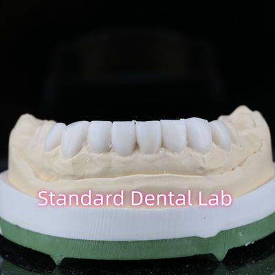 kopen Diagnostische Restoratieve Tandheelkunde Wax Up Veneers Hoge esthetiek online vervaardiging