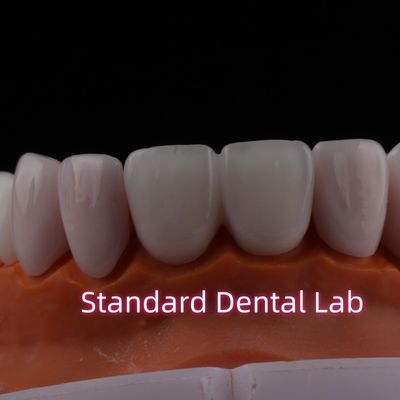 kopen Translucent Emax Zirconia Laminate Veneers Porselein Tandheelkundige Veneers Chemisch Verystable online vervaardiging