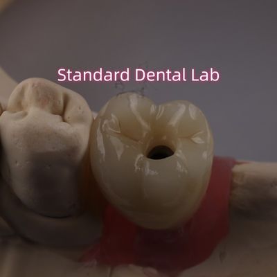 kopen Schroef vastgehouden tandheelkundige implantaat kroon PFZ porselein gelaagd zirconia online vervaardiging