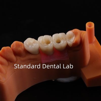 kopen Porselein Zirconia Tandheelkundige Implantatie Brug Professionele Hoge Esthetiek online vervaardiging