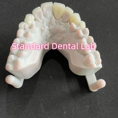 kopen Star's Smile Tandheelkundige Tanden Emax Zirconia Laminate Veneers 0.6mm online vervaardiging