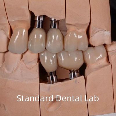 kopen Natuurlijk uitziende esthetische schroef met gereserveerde circonia-implantatie kroon online vervaardiging