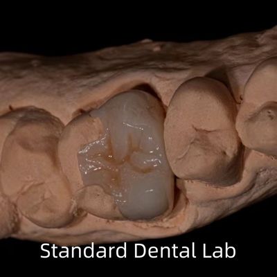 kopen Translucide Emax Zirconia Tandheelkundige Inlay Onlay Kroon Voor Herstel Natuurlijke holte vorm online vervaardiging