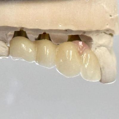kopen Porselein Zirconia Cement Retined Schroef Implant Hexagonale hoofdvorm voor Custom Fit Esthetics online vervaardiging