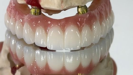 kopen Tandheelkundige All On X Implantat PFM Crown Titanium Fixed Hybrid Prothese online vervaardiging