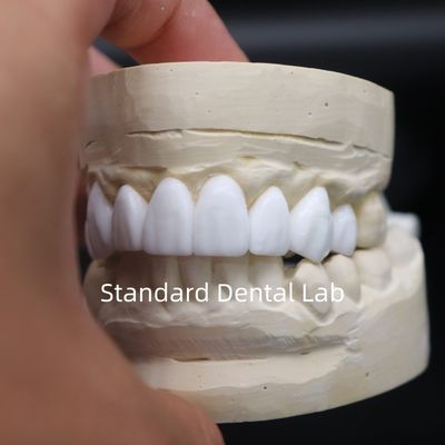 kopen Tandkronen diagnostische wax-up hoge esthetiek uit China tandheelkundig lab online vervaardiging