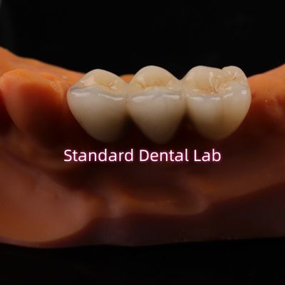 kopen Digitale CAD CAM tandheelkundige lab kronen doorzichtige gelaagde Zirconia kroon online vervaardiging
