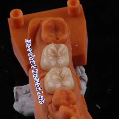 kopen Volledige contour Zirconia kroon doorzichtigheid 3D PRO Geen porseleinen overlay Standaard tandheelkundig laboratorium online vervaardiging