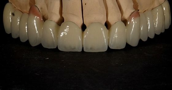 kopen Goed geschikt Goed esthetisch Meerdere lagen Zirconia Kroon Porselein Zirconia Brug online vervaardiging