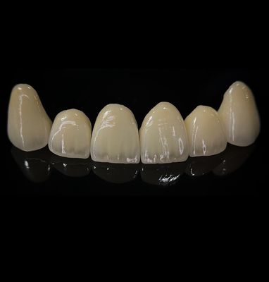 kopen Een comfortabele circonia kroon met een goede pasvorm en een precieze esthetiek online vervaardiging