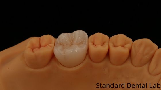 kopen Noritake Porselein Full Contour Zirconia Crown Customized Vita Shade voor esthetische digitale tandheelkundige restauratie door tandheelkundig lab online vervaardiging