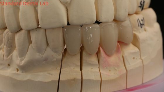 kopen Zware tandheelkundige lab kronen 3D Pro High Translucency Full Zirconia kronen met Vita schaduw op maat online vervaardiging