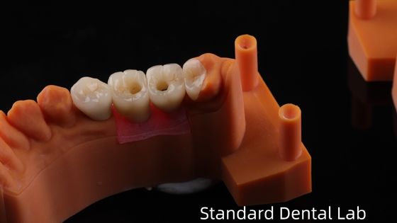 kopen Schroef vastgehouden tandheelkundige implantaat kroon met PFZ porseleinen gelaagd zirconia 5 jaar garantie en 3D print model online vervaardiging