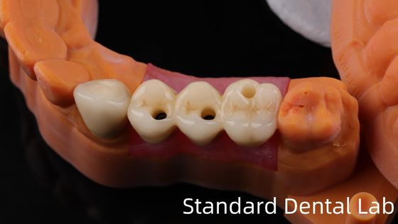 kopen Professionele Zirconia tandheelkundige implantaten kroon Titanium CAD CAM Zirconia kroon China tandheelkundig laboratorium online vervaardiging