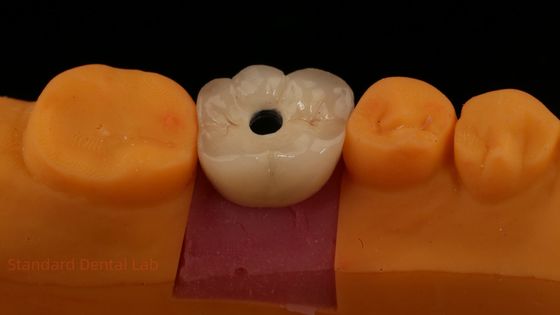 kopen Schroef vastgehouden PFZ porselein gelaagd Zirconia tandheelkundige implantaat kroon van tandheelkundig laboratorium ISO FDA CE gecertificeerd met 5 jaar garantie online vervaardiging