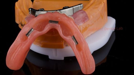 kopen Ivoclar Digitale Tandheelkundige Implantaten Bar Prothese met Bijlagen Volledige Acryl Prothese Titanium Implantaten Ondersteunde Prothesen online vervaardiging