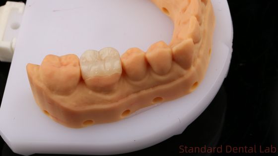 kopen Translucent Zirconia tandheelkundige inleg Onlay kroon voor het herstellen van de natuurlijke holte vorm / Standard tandheelkundige laboratorium online vervaardiging