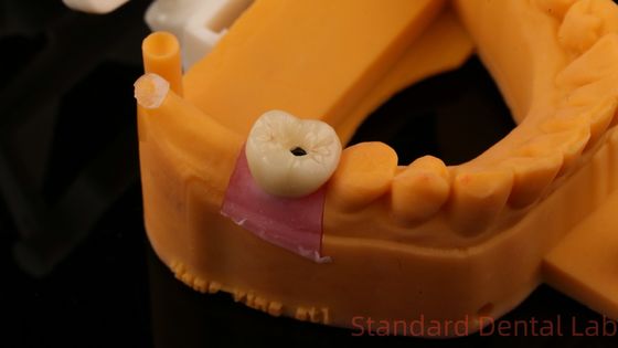 kopen Tandheelkundige implantaat schroef vastgehouden kroon PFZ porselein gelaagd zirconia met 3D-print model online vervaardiging