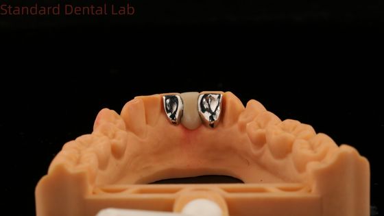 kopen Tandheelkundige PFM Maryland Bridge High Esthetics FDA gecertificeerd met Vita Porcelian China Dental Lab online vervaardiging