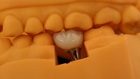 kopen Schroef vastgehouden tandheelkundige implantaat kroon tandheelkundige PFM kroon met 3D-print model online vervaardiging