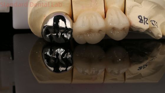 kopen Vita Porseleinen Volle Metalen Kroon Met Post Core 3 Jaar Garantie Van Tandheelkundig Lab online vervaardiging