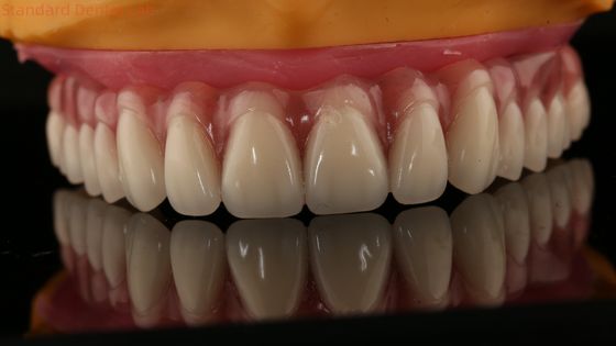 kopen Acryl gedeeltelijk implantaat over de tandheelkunde Titian balk Volledige tandheelkunde Tanden ingesteld Schroef vastgehouden online vervaardiging