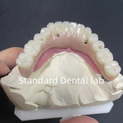 Esthetische restauratie Alle op 4 tandheelkundige implantaten Zirconia Hypoallergeen