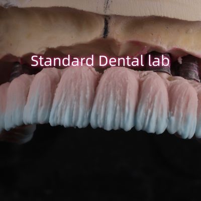 Zirconia-implantatiebrugschroef vastgehouden met roze porseleinen