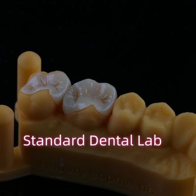 Composite Harz Zirconia Emax Metal Inlay Onlay Overlay
