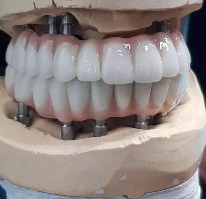 Precies vervaardigd circonia-screwcement voor implantaten dat wordt gebruikt voor natuurlijke tanden
