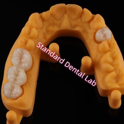Kroon Al Porselein Keramische Zirconia Ivoclar Esthetische Tanden OEM