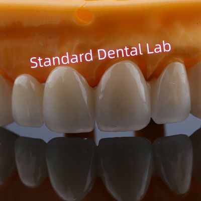Restoratie van de voorkant Zirconia brugkronen voor ontbrekende tanden