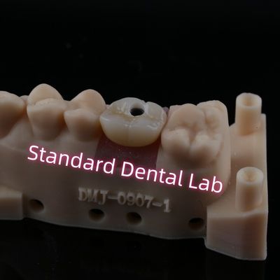 Op maat gemaakte abutment-implantatie kroon volcontour Zirconia schroef vastgehouden