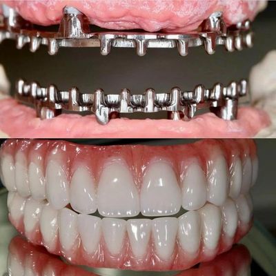 Tandheelkundige Hybird Malo Implant Bridge Professional Perfect Fit FDA gecertificeerd