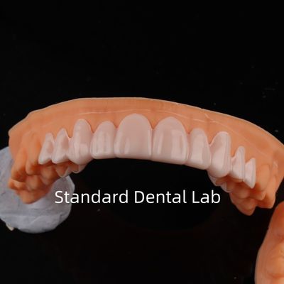Hoge esthetiek tandheelkundige snap op glimlach standaard tandheelkundige lab