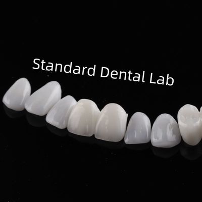 Hoge esthetische tanden Emax laminaat veneers Incisiale doorschijnendheid
