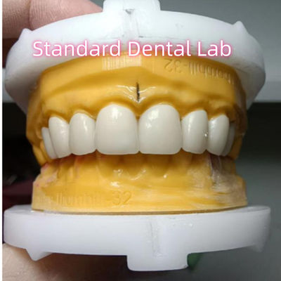Ivoclar Zirconia Crown Veneers Hoogtranslucentie