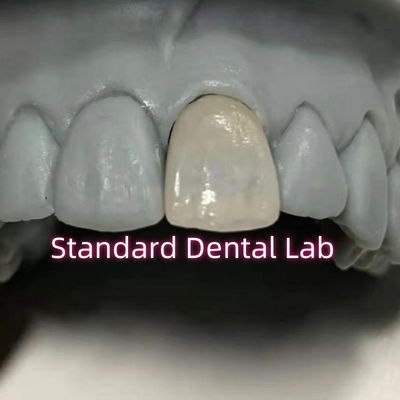 Restoratieve tandheelkunde Emax Tandheelkundige Zirconia Porseleinkronen