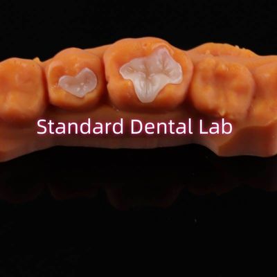 Dental Porcelain Inlay Onlay Overlay Zirconia Emax Composite Voor tandbederf