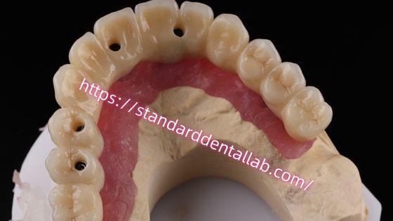 Multi-layer Zirconia schroef vastgehouden implantaat brug Biocompatibel op metalen structuur