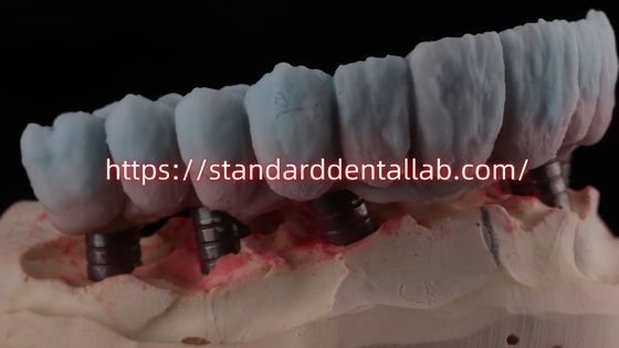 Implantate ondersteunde Zirconia brug met titanium abutment