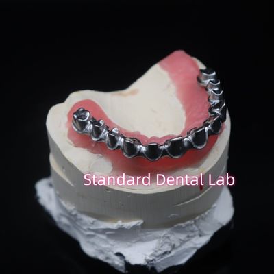 Full Arch Malo Bridge Tandheelkundige restauratie Zirconia kronen met kauwgom Poecelian China Tandheelkundige Lab