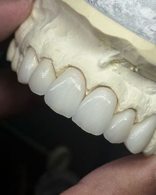 Translucent gelaagde zirconia kroon voor optimale functionaliteit en natuurlijke esthetiek