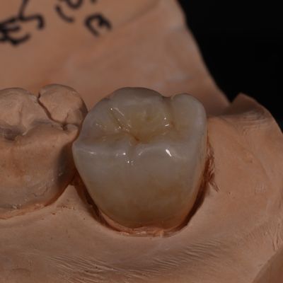 Volledige contour doorschijnende circonia kroon voor esthetisch aangename resultaten