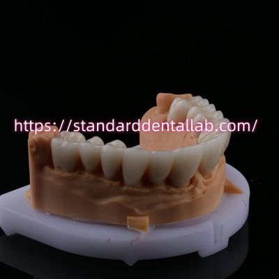 FDA High Esthetics Dental Zirconia Bridge met gelaagde porseleinen circonia tandkronen China Dental Lab