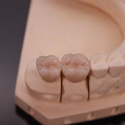 Comfortabele Zirconia kroon met precieze esthetische afwerking Express 3-4 dagen rondlooptijd